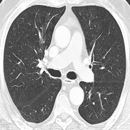Axial thoracic CT slice from the research